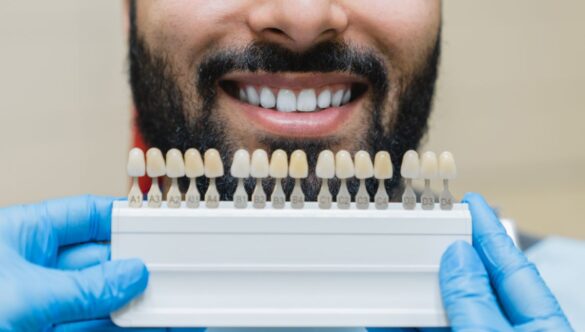 3 Types Of Dental Veneers