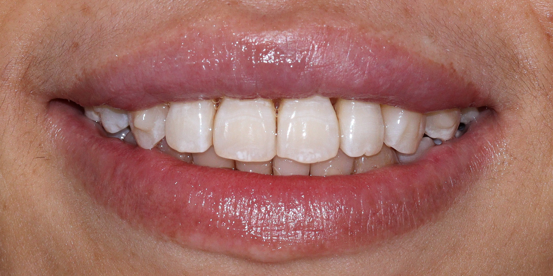 Invisalign1 After