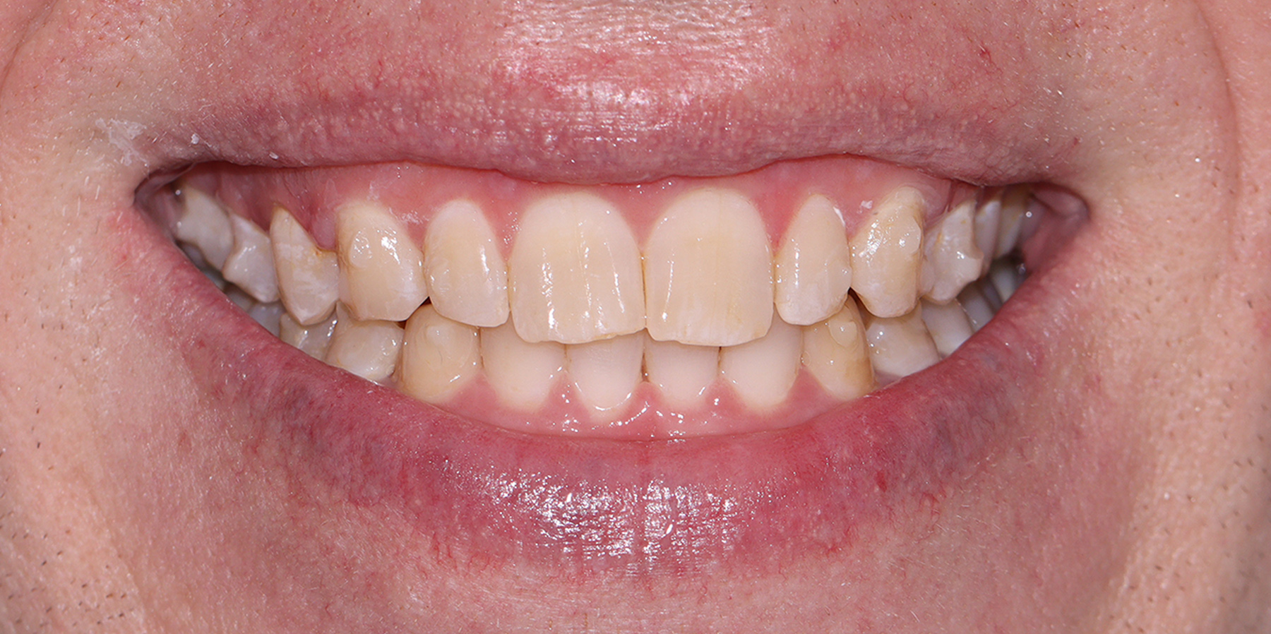 Invisalign2 After