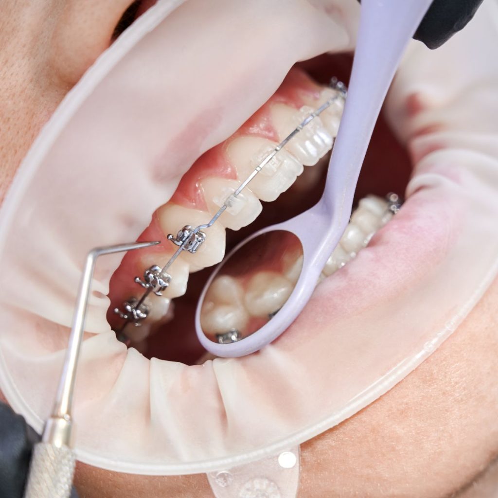 Common Misconceptions About Braces