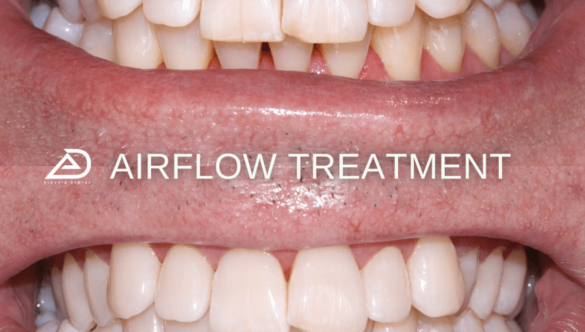 How To Care For Your Teeth After A Dental Airflow Treatment