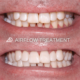 How To Care For Your Teeth After A Dental Airflow Treatment