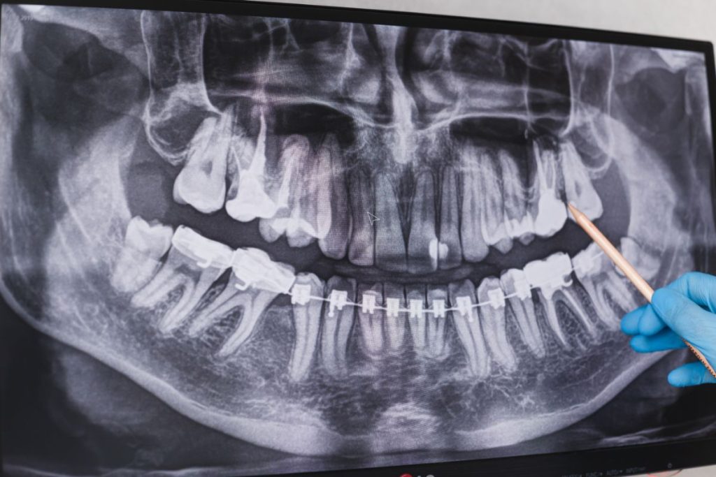 Doctor Points To Cured Filled Tooth In Dental X Ra 2022 12 16 21 46 44 Utc 1 1024x683