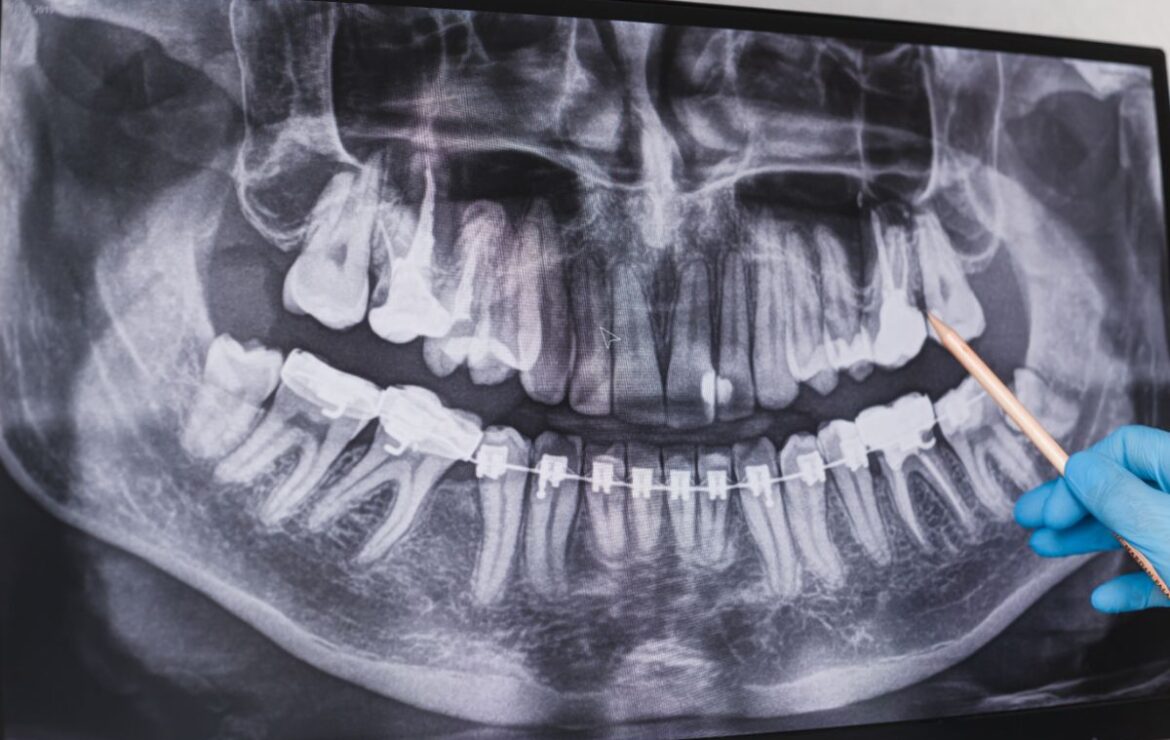 When Should You Have a Wisdom Tooth Extraction