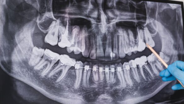 When Should You Have a Wisdom Tooth Extraction