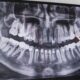 When Should You Have a Wisdom Tooth Extraction