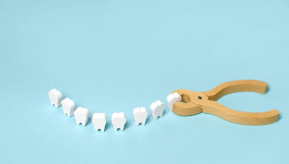 What is Wisdom Tooth Extraction? 3 Things You Need to Know