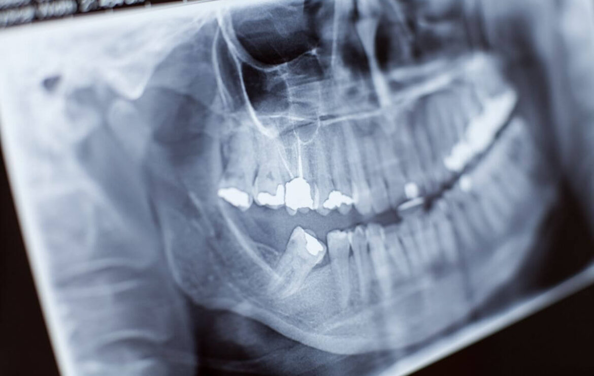 Symptoms of Impacted Teeth