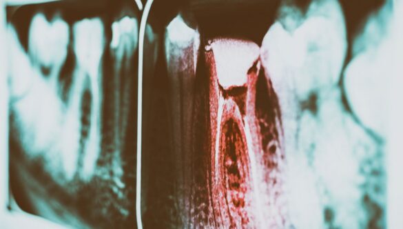 Symptoms of Tooth Decay