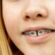 4 Causes of Gap Between Teeth And The Best Solution For It