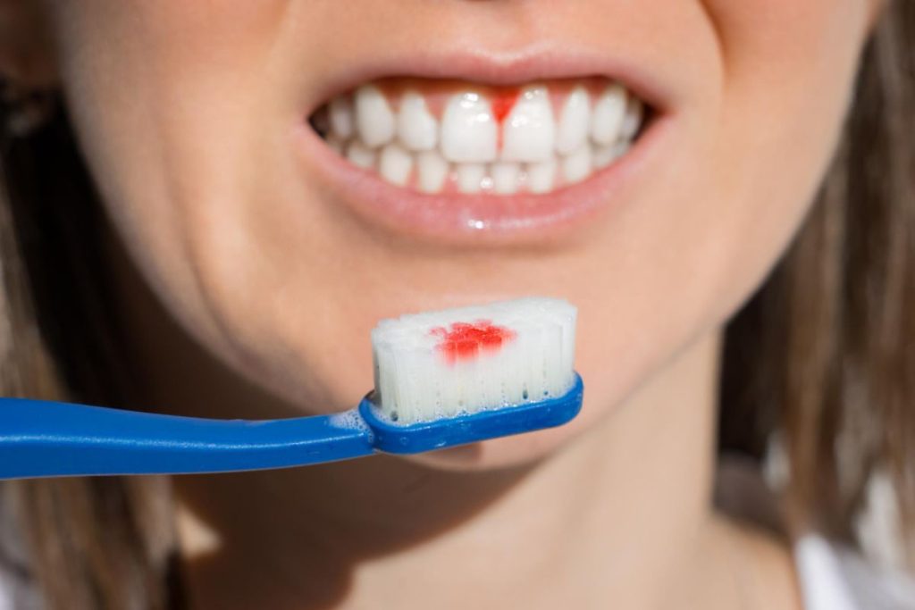 Woman Mouth With Bleeding Gums During Teeth Brushing Periodontal Disease Avitaminosis Gingivitis 1024x683