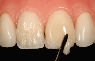 Direct Composite Veneers Dental Tourism