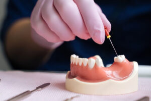 Root Canal Treatment Myths: Unveiling the Facts