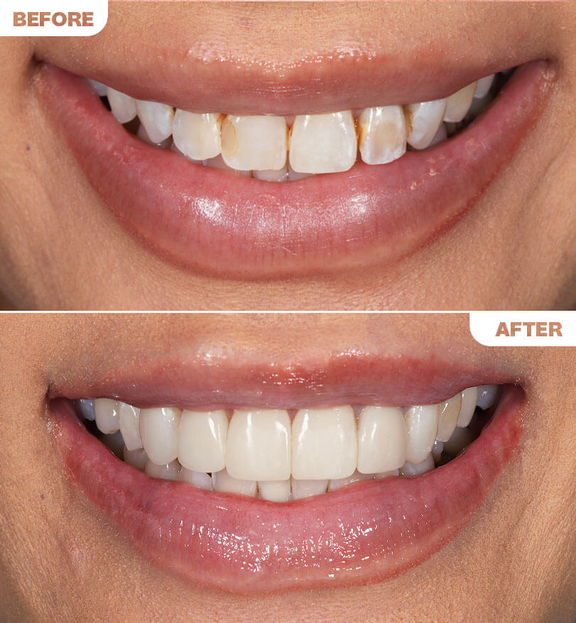 Composite Veneers B&A