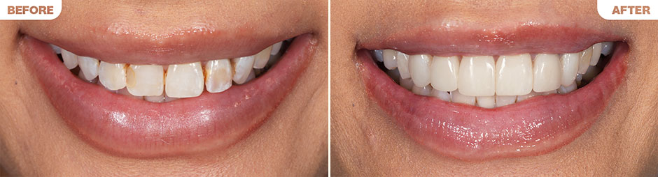 Composite Veneers B&A