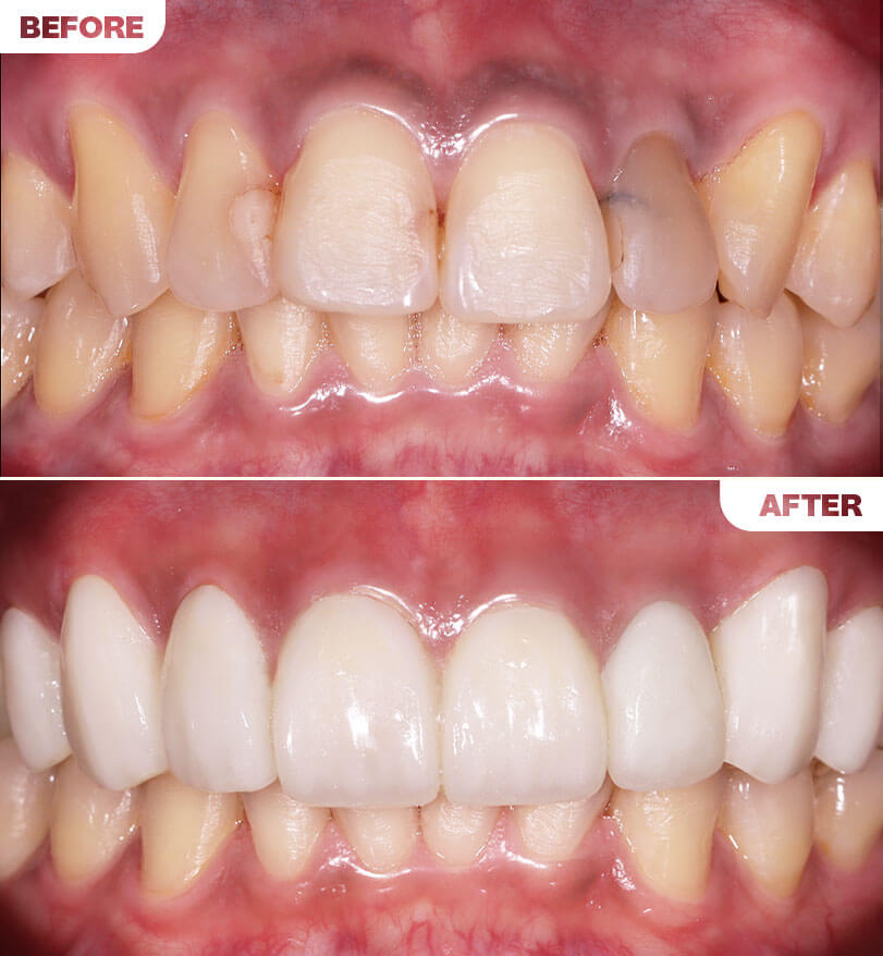Porcelain Veneers B&A