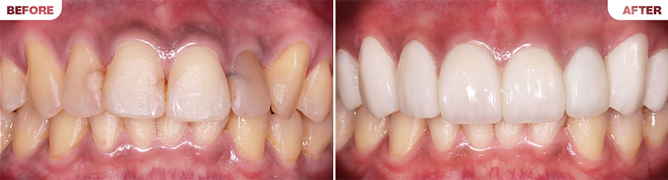 Porcelain Veneers B&A