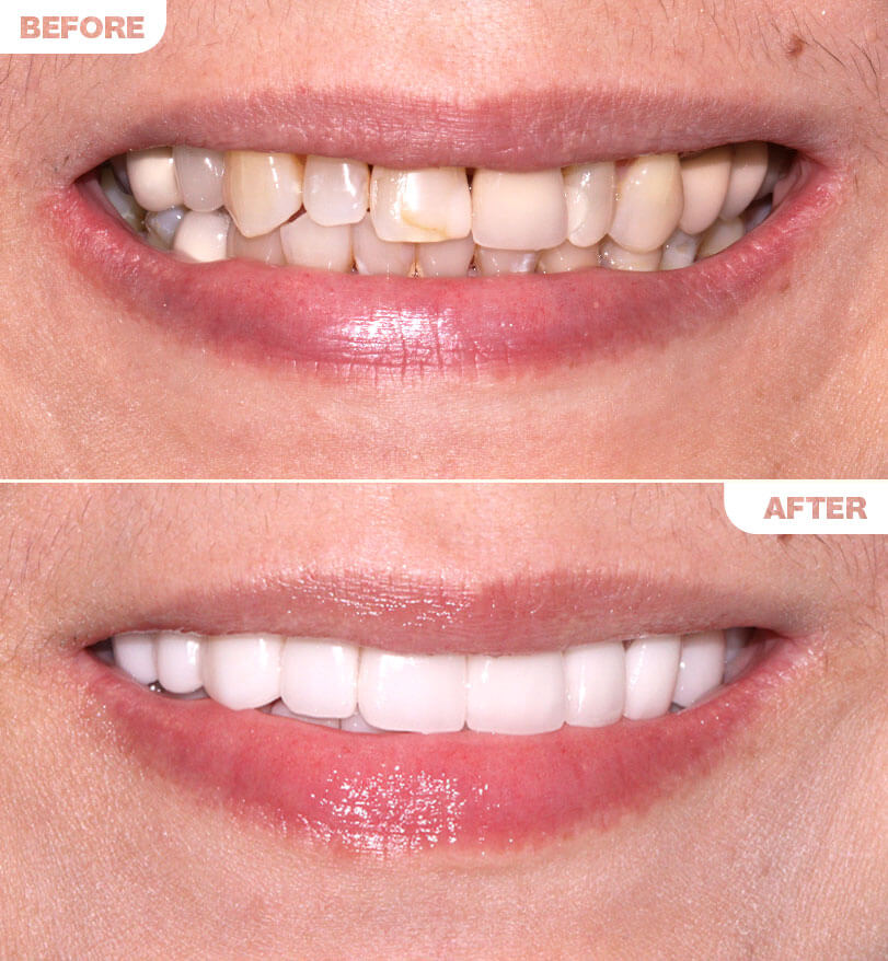 Zirconia Veneers B&A