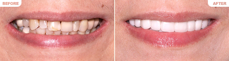 Zirconia Veneers B&A