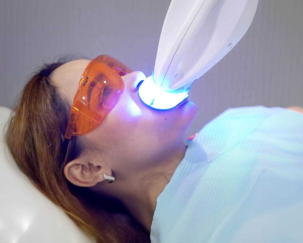 Laser Teeth Whitening