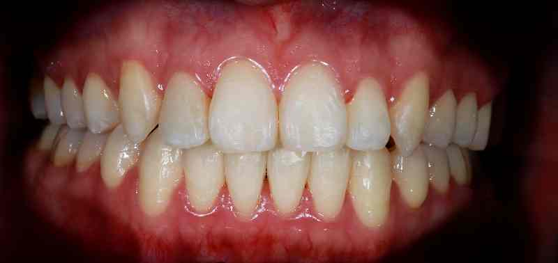 Service Braces BnA After 11zon