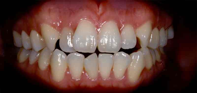 Service Braces BnA Before 11zon