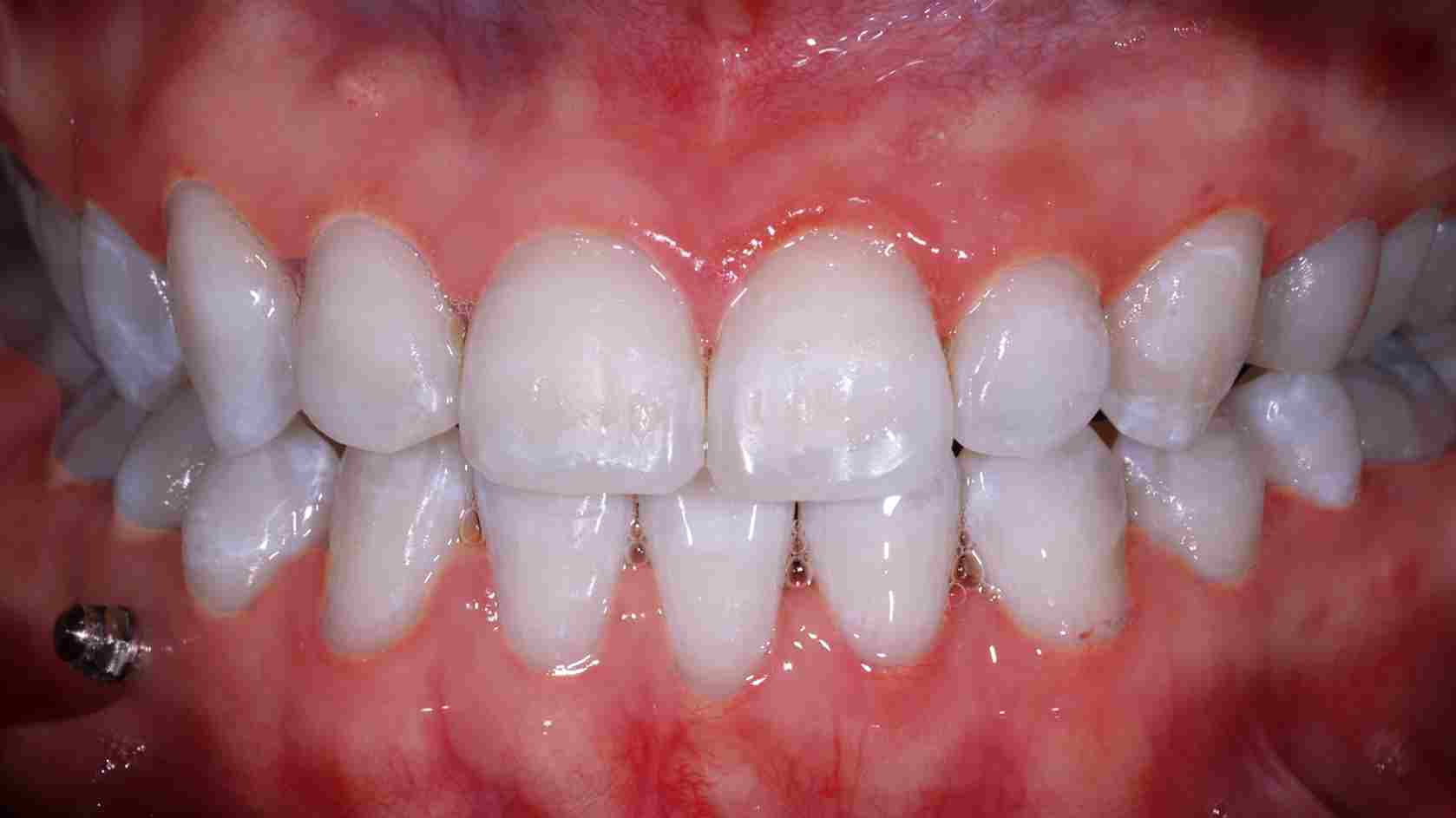 Service Teeth Whitening BnA After 11zon