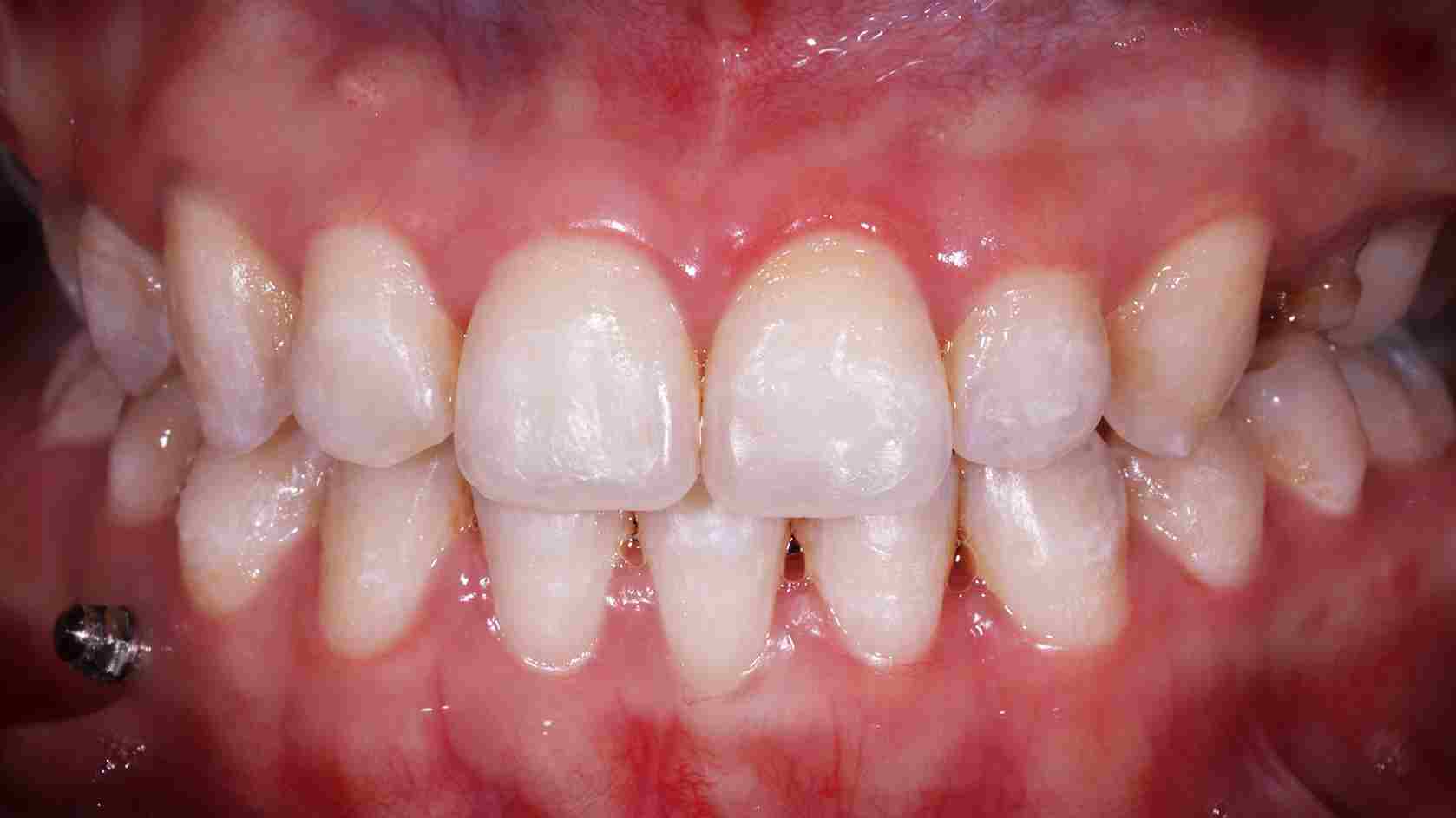 Service Teeth Whitening BnA Before 11zon