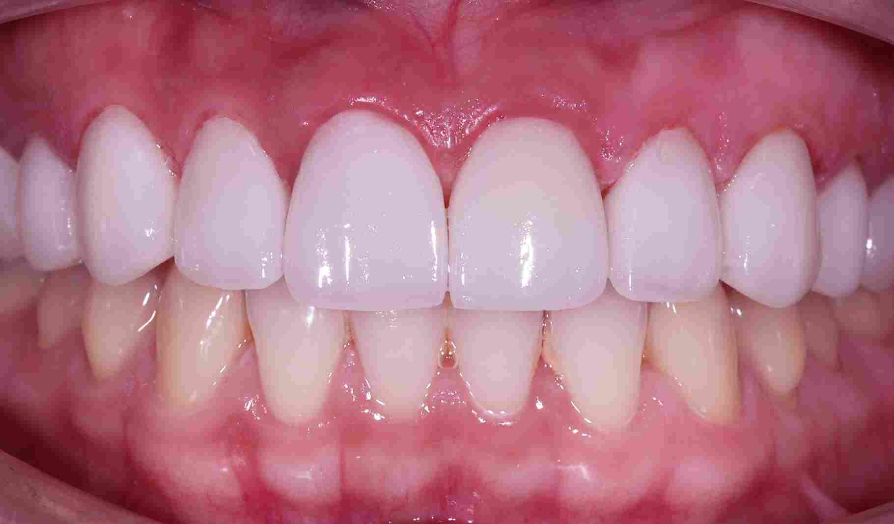 Service Veneers BnA After 11zon