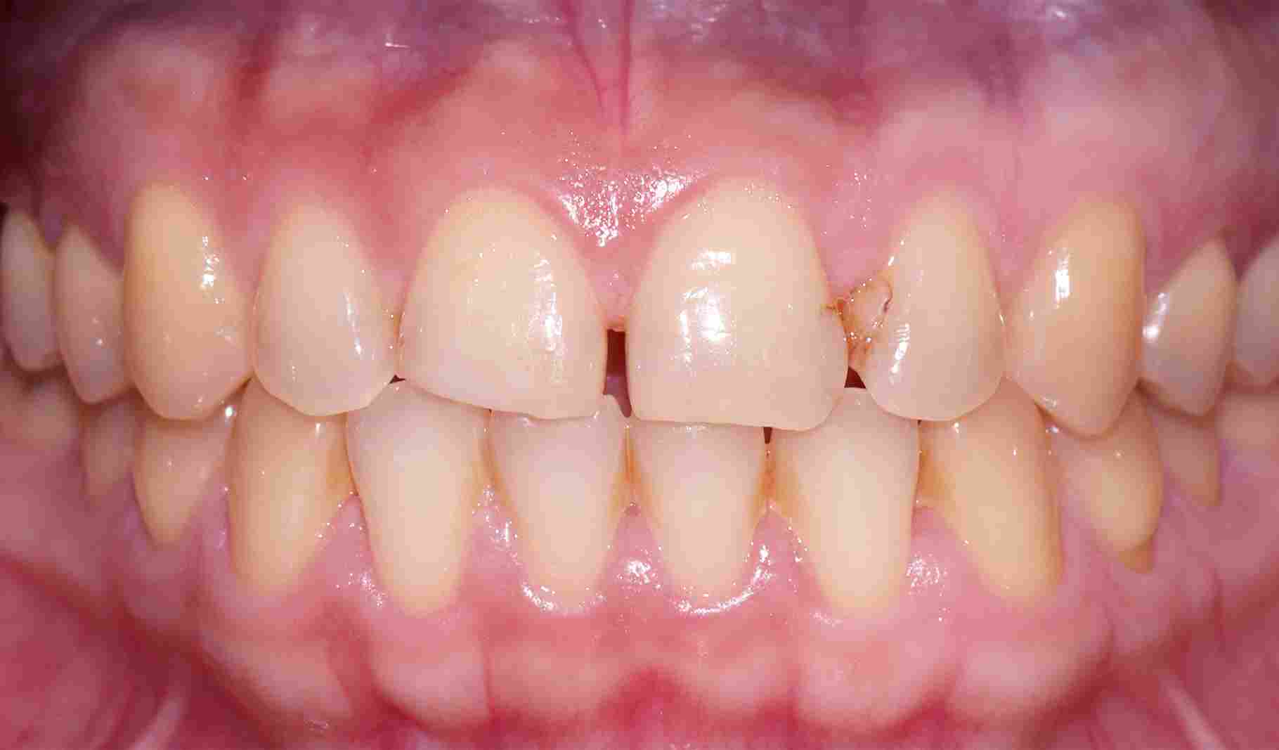 Service Veneers BnA Before 11zon