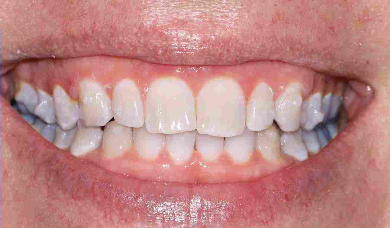 Service Invisalign BnA After 11zon