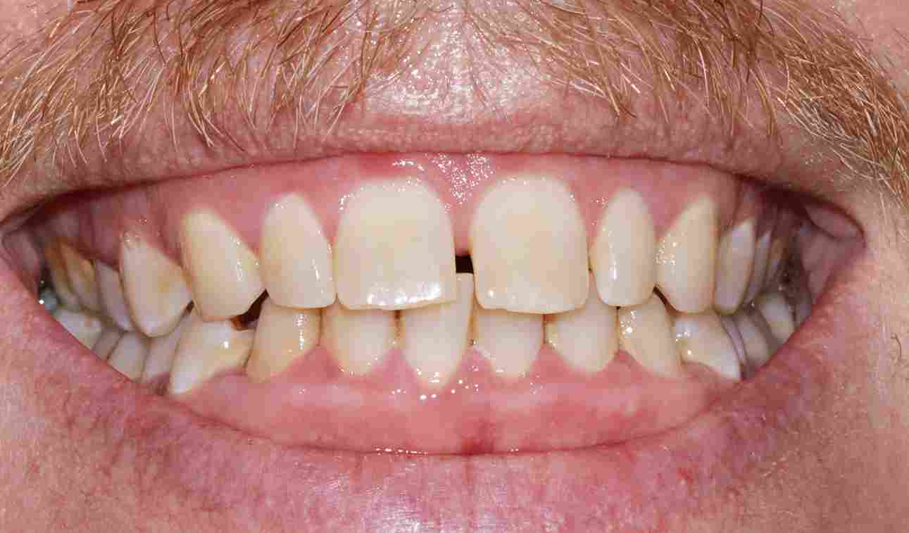 Service Invisalign BnA Before 11zon