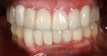 Dental-Bridge---BnA-6---Salvacion-Amago_After