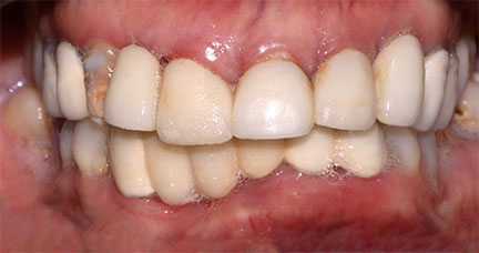 Dental-Bridge---BnA-6---Salvacion-Amago_Before