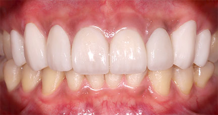 Porcelain---BnA-2---Discolored-Teeth,-Old-Restoration---Kenneth-Viterbo_After