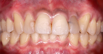 Porcelain---BnA-2---Discolored-Teeth,-Old-Restoration---Kenneth-Viterbo_Before