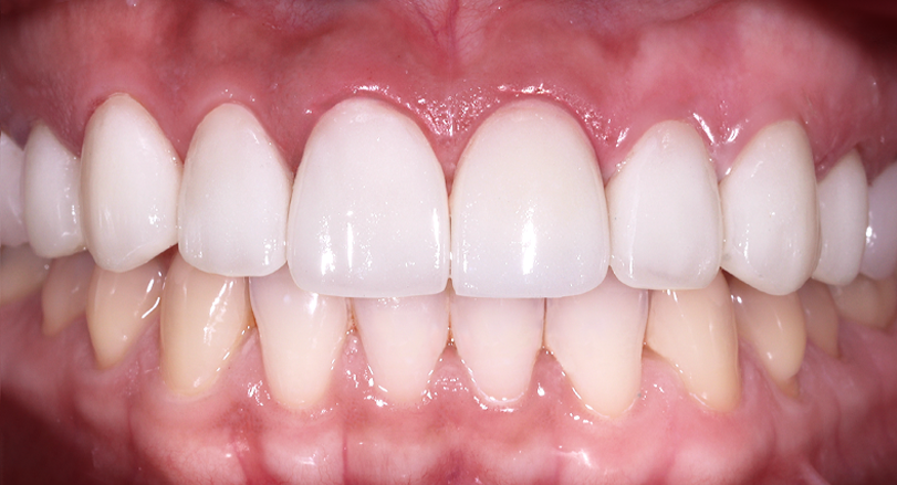 After Dental Veneers Teeth Restoration