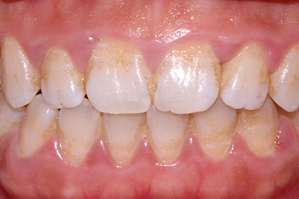 airflow-bna2-before