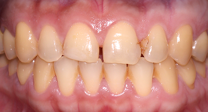 Before Dental Veneers Teeth Restoration