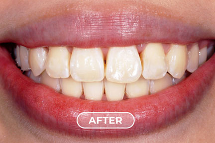 bite-problem-after