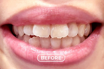 bite-problem-before