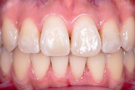 braces-bna1-after
