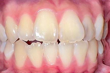 braces-bna1-before