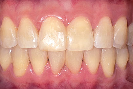 braces-bna2-after