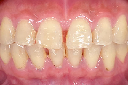 braces-bna2-before