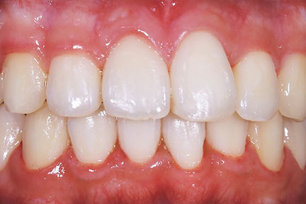 braces-bna3-after