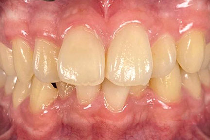 braces-bna3-before