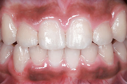 braces-bna4-after