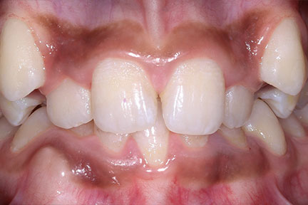 braces-bna4-before