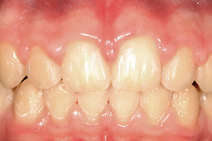 braces-bna5-after